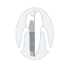 Tucson Dental Implants & Periodontics Dental Implant