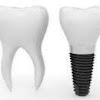 Western Mass Periodontics Dental Implant